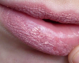 /73/Beauty/Droge lippen.jpg